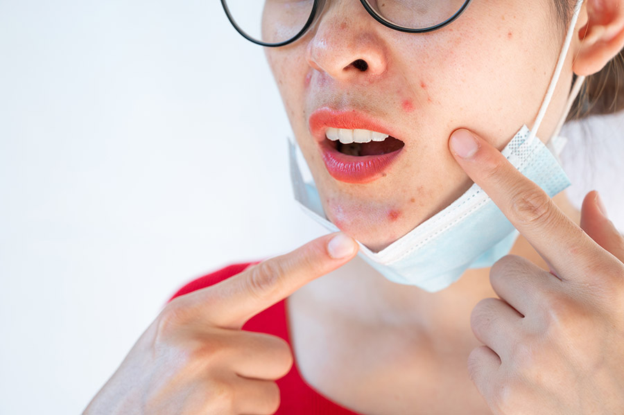 Woman pointing acne Inflamed occur on her face after wearing mask for long time during covid-19 pandemic. Wearing mask for prolonged periods can damage the skin.